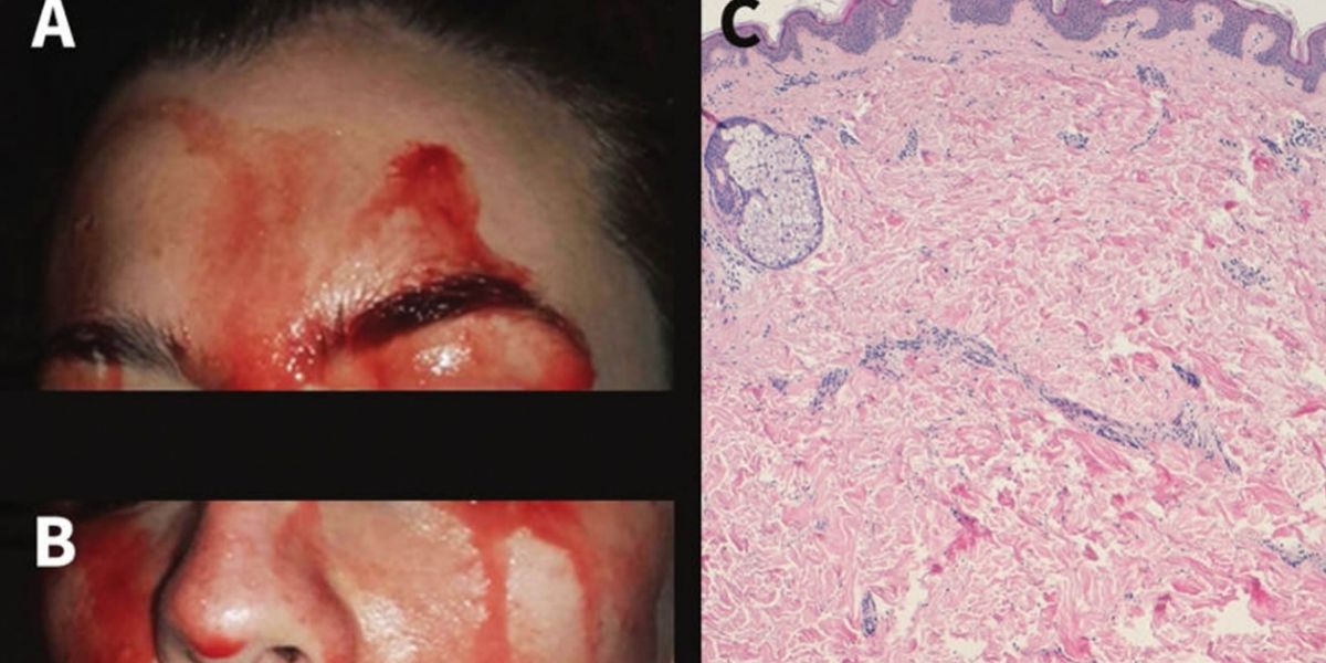 Twitter. Joven italiana que suda sangre por las manos y cara.