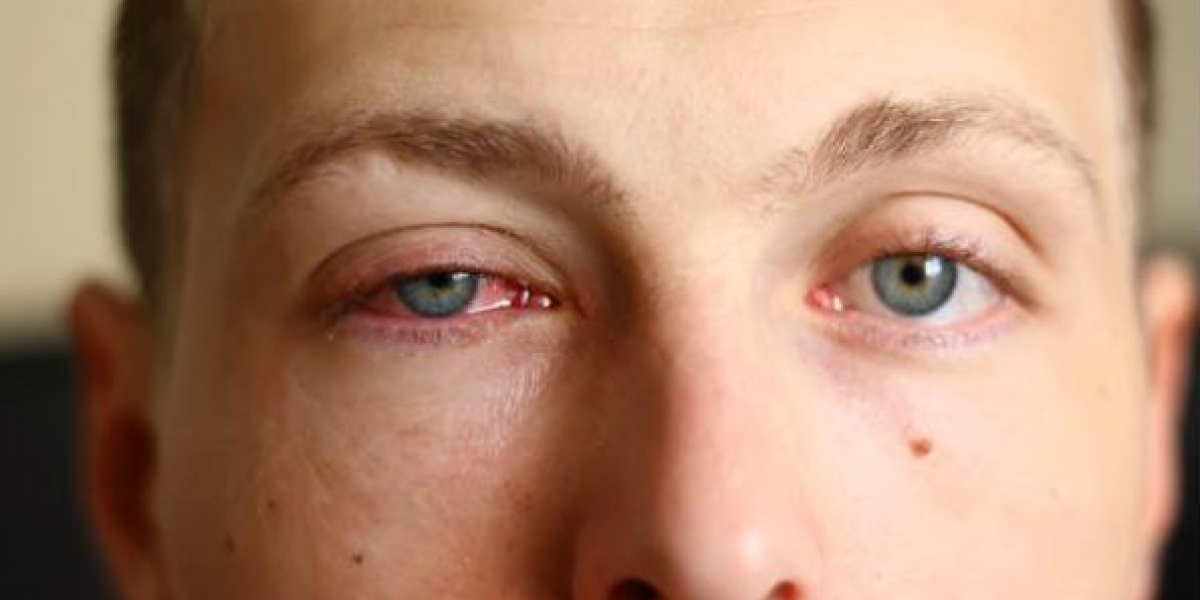 La conjuntivitis no se puede prevenir.