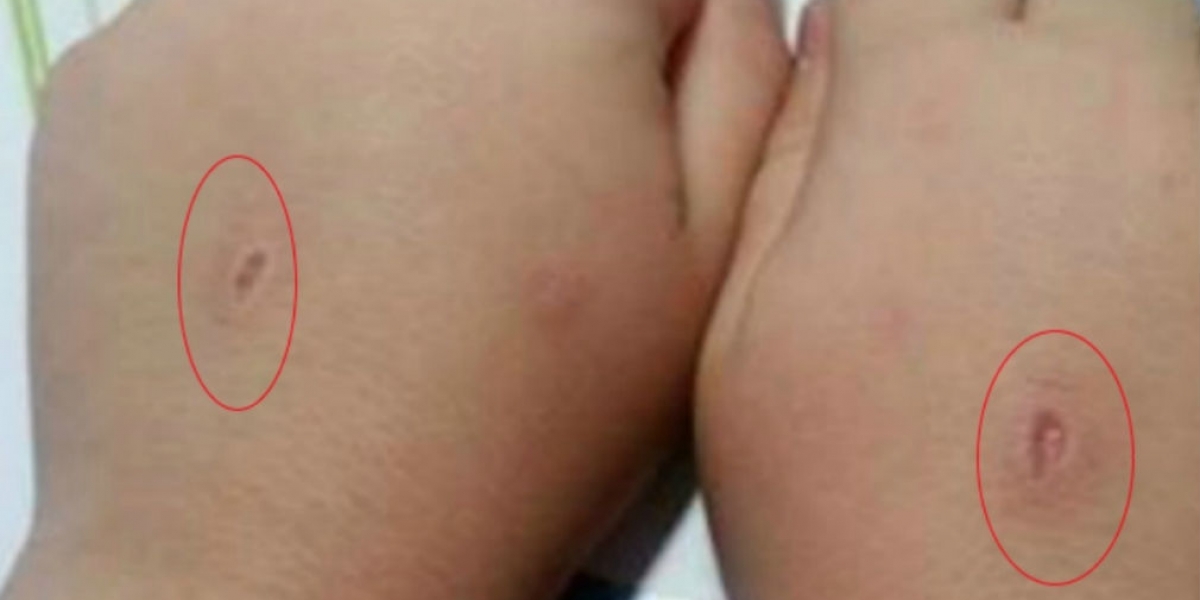 Zona Cero. Las heridas producidas en el juego.