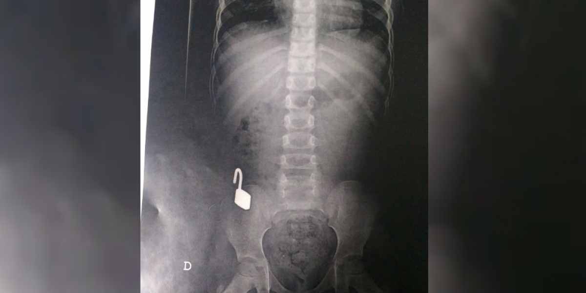 Suministrada La radiografía realizada por los médicos muestra el candado alojado en el aparato digestivo de la niña.