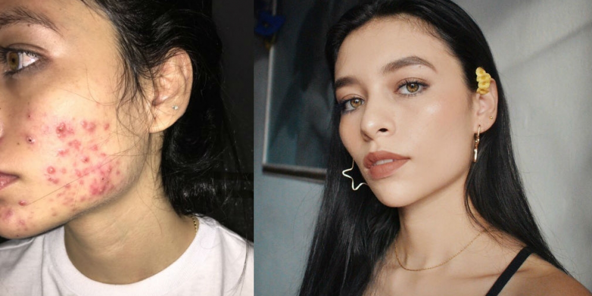 Seguimiento.co Camila Delgado, la tuitera que compartió su historia de acné.