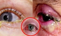 La conjuntivitis genera irritación de los ojos.