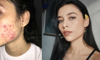 Camila Delgado, la tuitera que compartió su historia de acné.