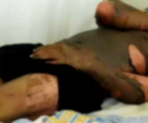 El paciente sufrió graves quemaduras en las piernas, por lo que necesitaba ser valorado por un especialista.