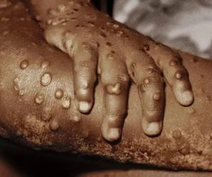 Viruela del mono, la grave enfermedad que se propaga por Europa.