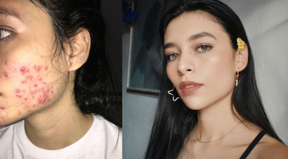 Seguimiento.co Camila Delgado, la tuitera que compartió su historia de acné.