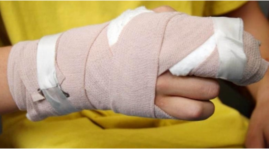 Secretarías de Salud municipales reportaron 4 casos de quemados por pólvora en el Magdalena.